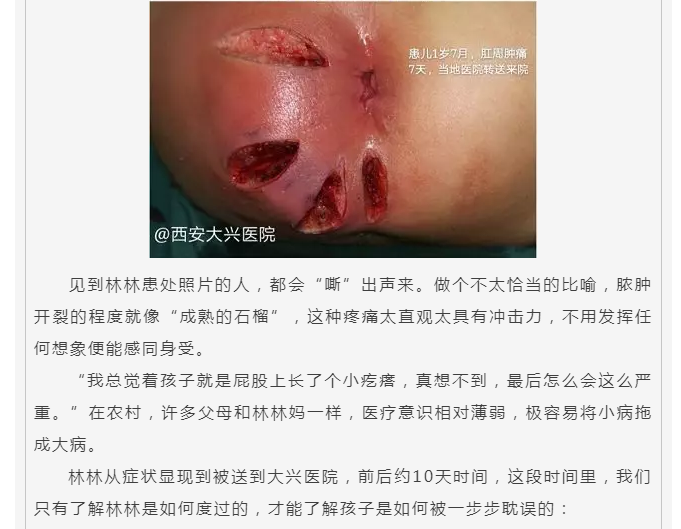 屁屁烂掉的大兴救赎记